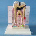 Human Pathological Teeth Anatomy Model for Demonstration